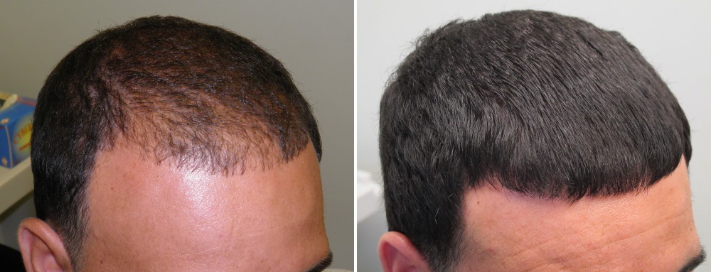 how to regrow hair from hair loss